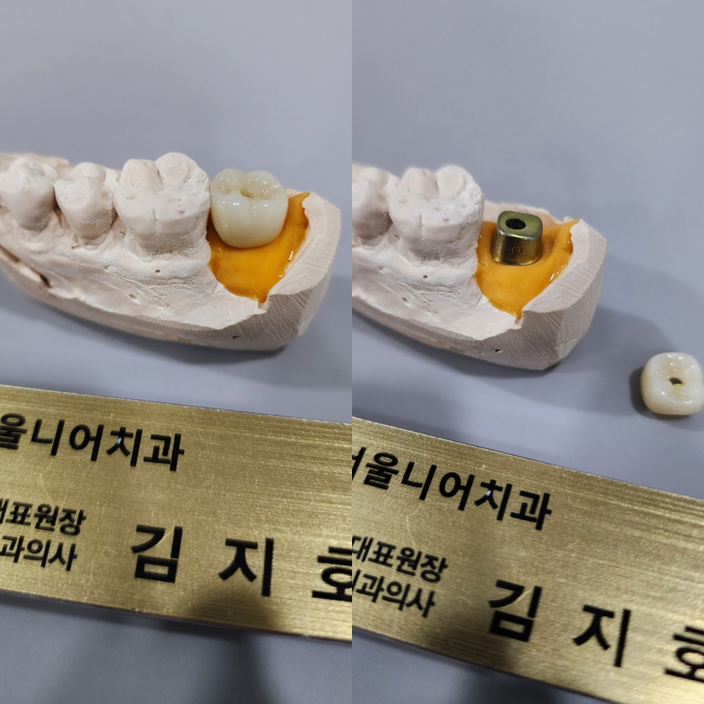 천안 임플란트 추천 치과 선택 기준 진단 보철 사후관리 요약
