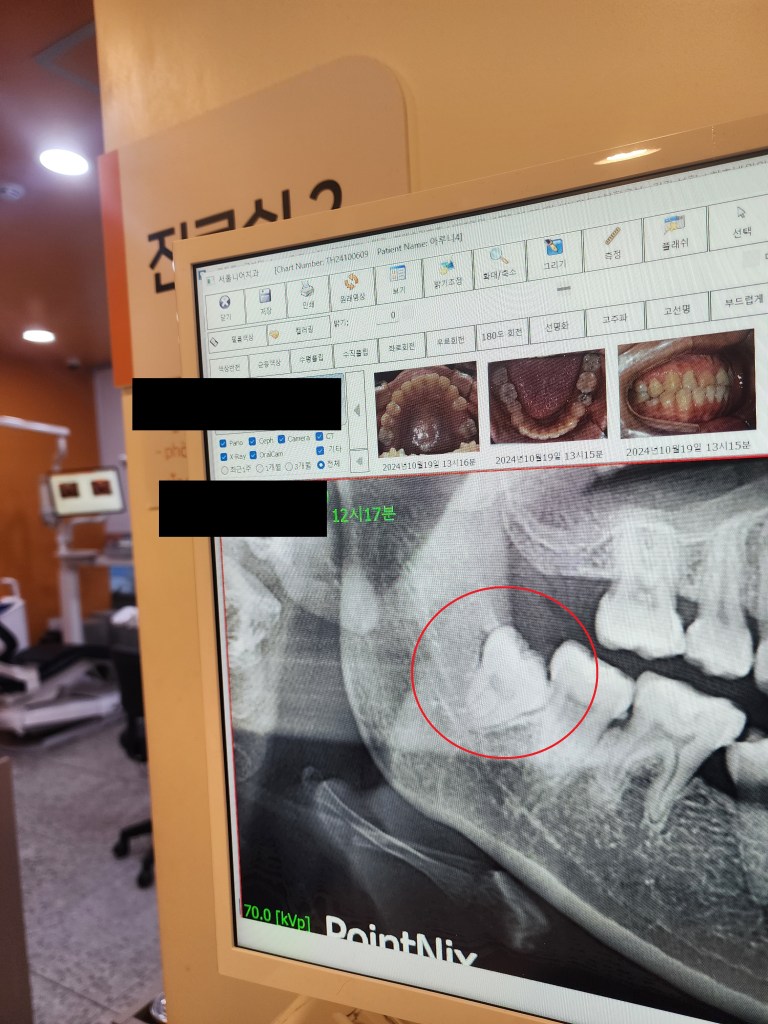 치과 엑스레이 화면으로, 하악에 있는 일부 치아가 강조되어 표시됨.