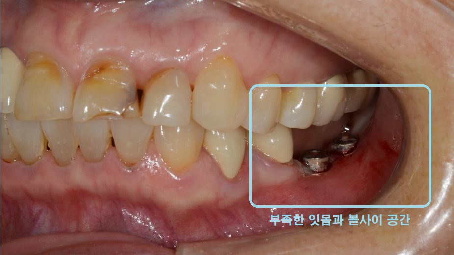 임플란트 음식물 끼임 잇몸 붓기 보철 교합 문제 원인 설명