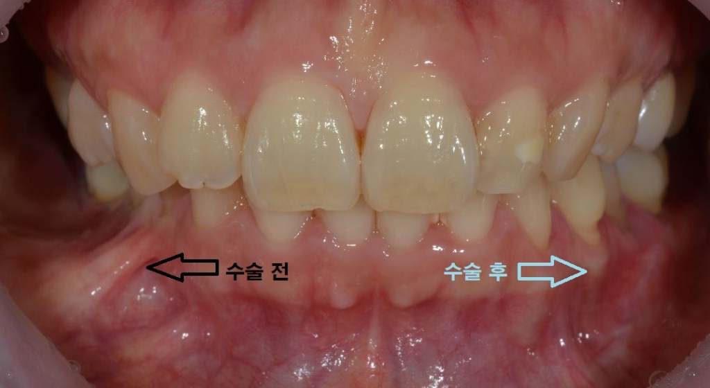 치아 치료 전후 사진으로, 치료 전과 후의 치아 상태를 비교한 이미지