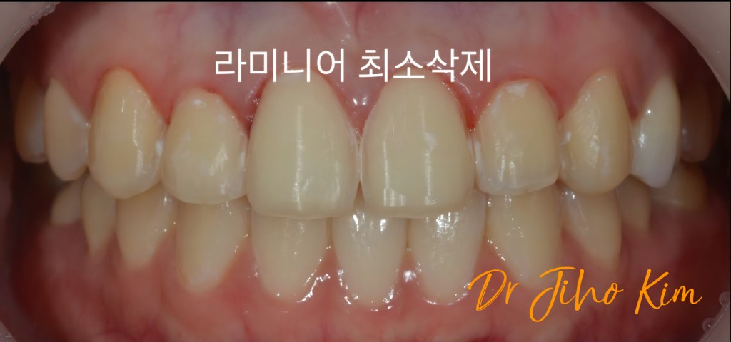 치아의 클로즈업 사진으로, 라미니어 최소 삭제에 관한 내용이 있는 이미지입니다.
