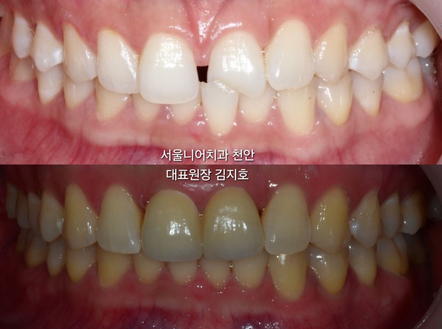 치아의 전후 비교 이미지, 상단은 치료 전, 하단은 치료 후 모습