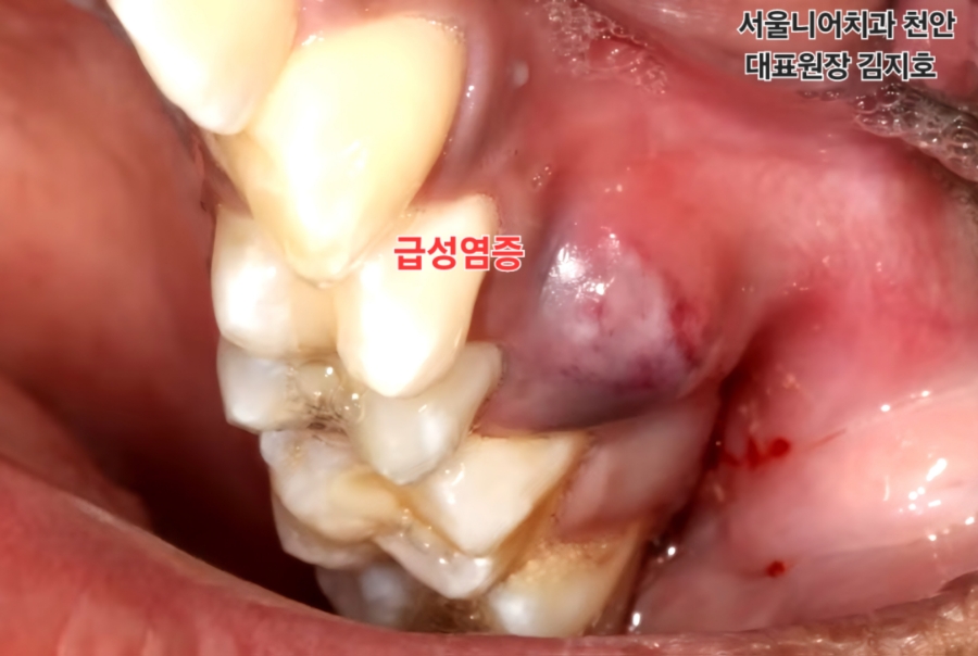 환자의 입 안 사진으로, 충치와 관련된 염증이 보이며, 급성염증의 표시가 있는 치아의 모습.