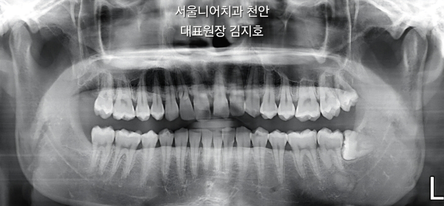 상하턱 치아의 엑스레이 이미지