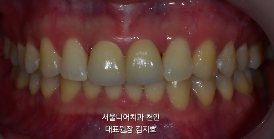 천안치과 심미교정 서울니어치과 천안