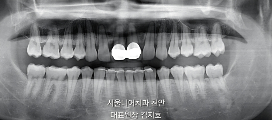 치아 엑스레이 사진으로, 치아와 잇몸 상태가 보인다.