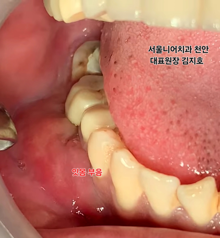 치아와 잇몸이 있는 입안의 이미지, 커다란 치아들이 보이고 잇몸 염증 부위에 대한 주석이 포함됨.