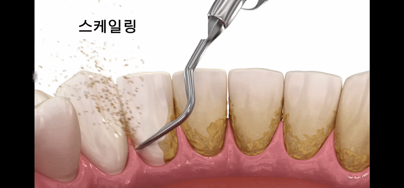치아에 스케일링 도구가 사용되어 플라크를 제거하는 이미지.