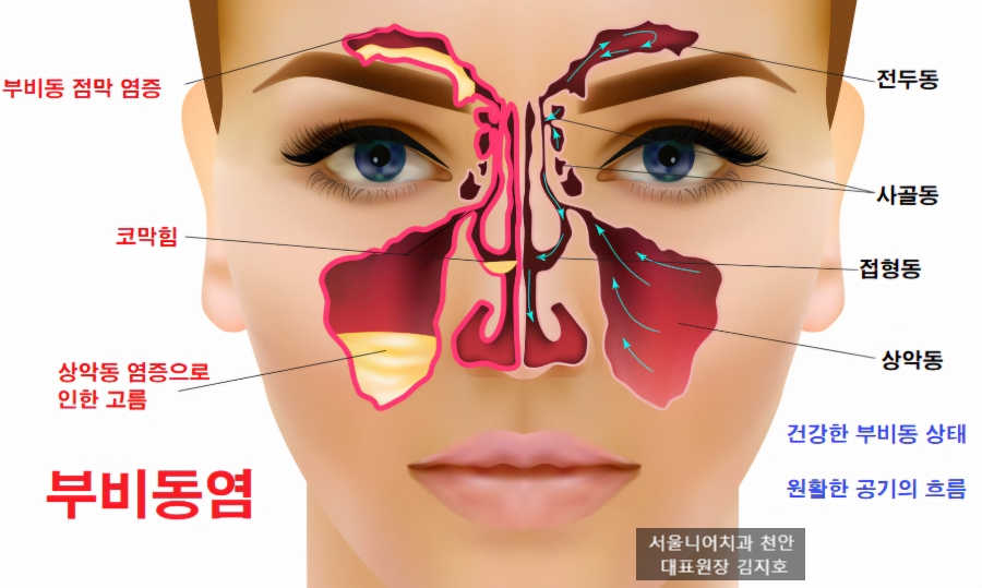 부비동염