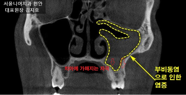 부비동염 CT