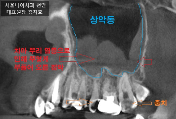 치성상악동염 CBCT