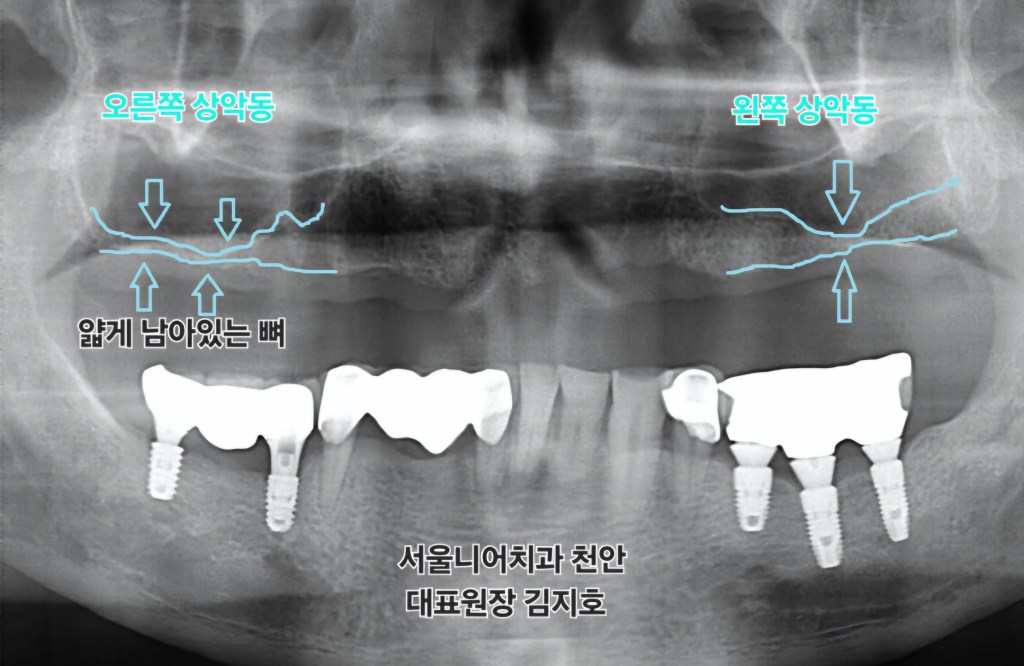 상악동함기화