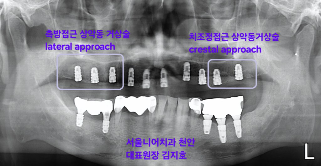 상악동거상술 측방접근 치조정접근
