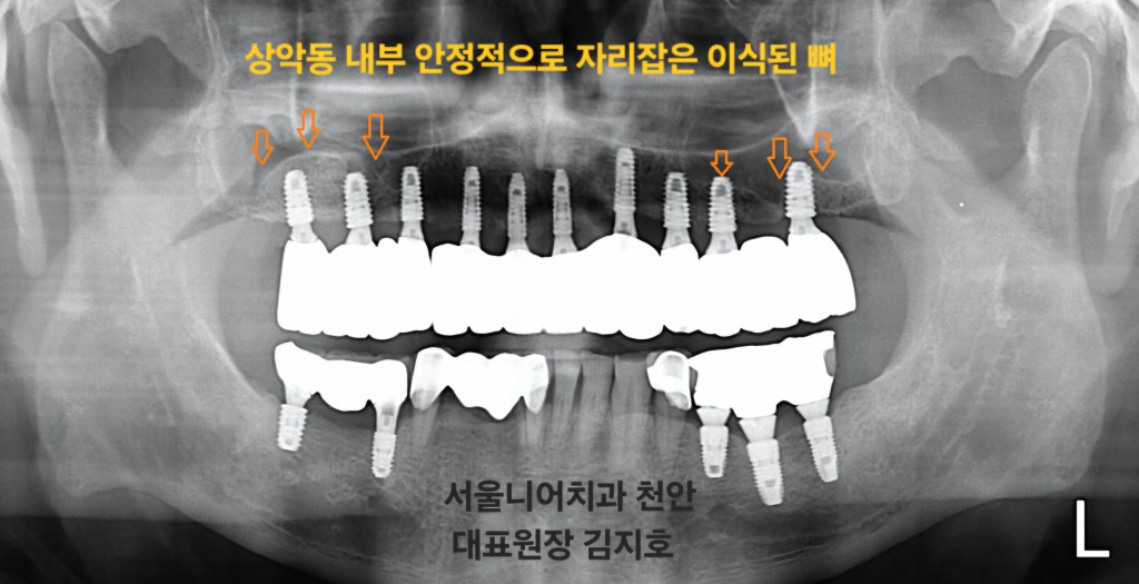 상악동 거상술 임플란트 서울니어치과 천안