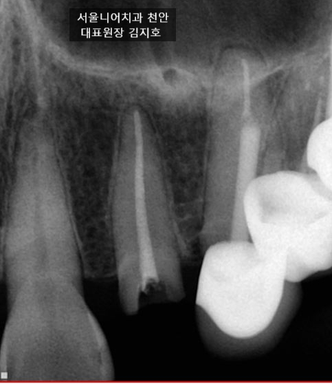 부러진 앞니 자연치아 보존 가능성 확인 엑스레이